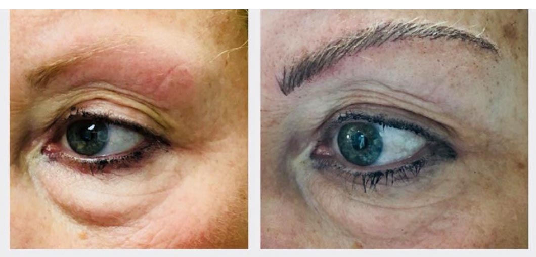 Microblading Microneedling Massapequa Ny Lotus Skin Care