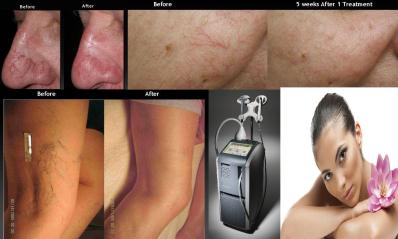 Hydrafacial Micro Needling Anti Aging Acne Scar Removal